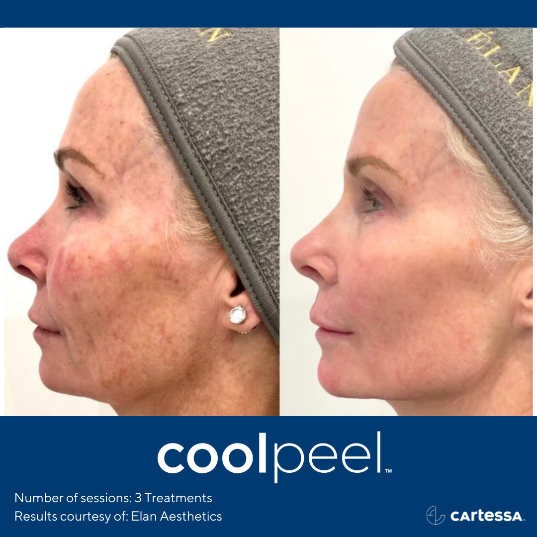 CoolPeel Before & after Treatment result in Manchester, NH by The Alchemy Clinic