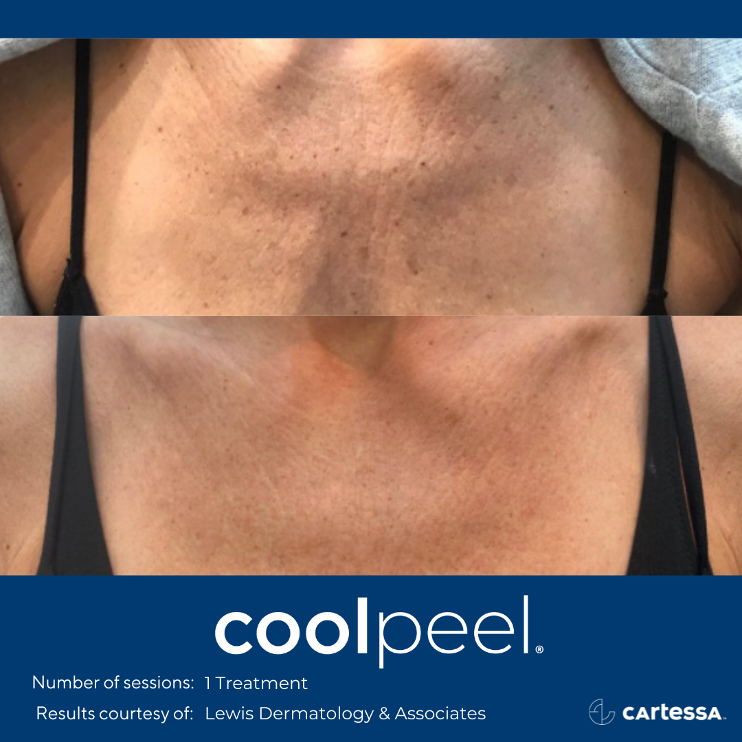 CoolPeel Before & after Treatment result in Manchester, NH by The Alchemy Clinic
