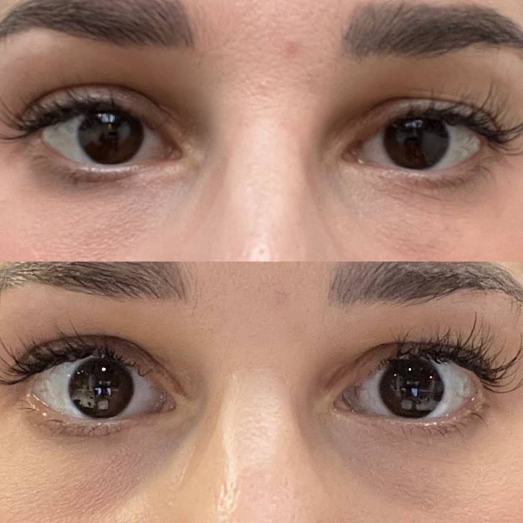 EYE CARE before & after Treatment in Manchester, NH by The Alchemy Clinic