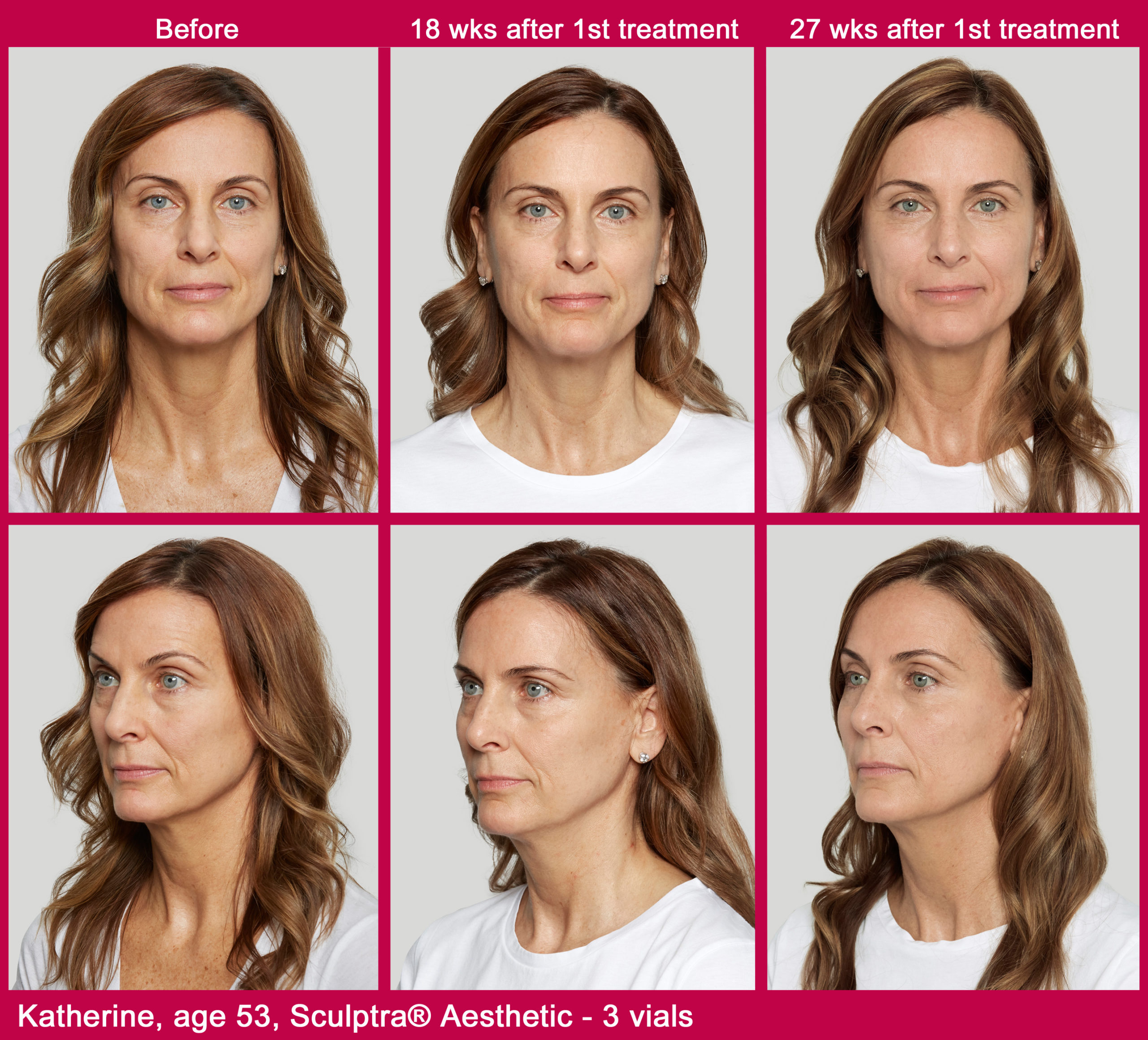 Sculptra Before & after Treatment result in Manchester, NH by The Alchemy Clinic