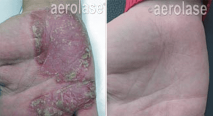 Aerolase Neo-Derm 3 Psoriasis1 Pair