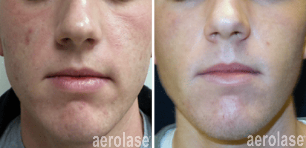 aerolase kevin pinski acne skin rejuvenation