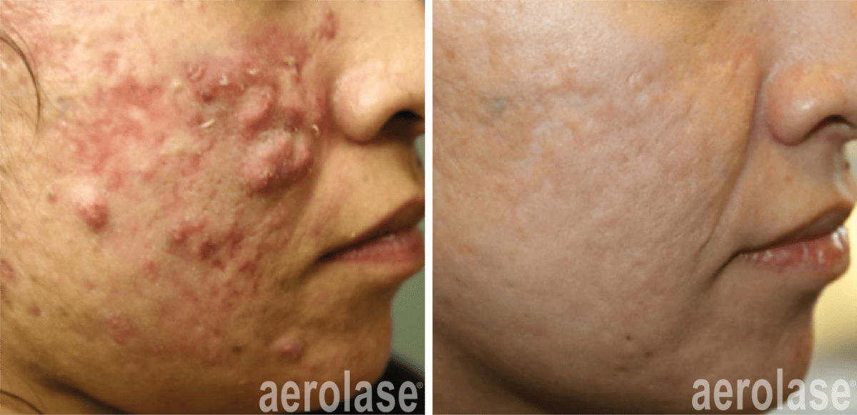 aerolase michael gold acne 5 treatments