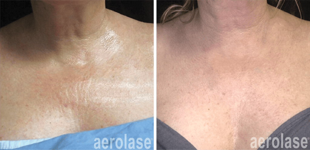 aerolase neoskin skin rejuvenation after 4 treatments jason emer