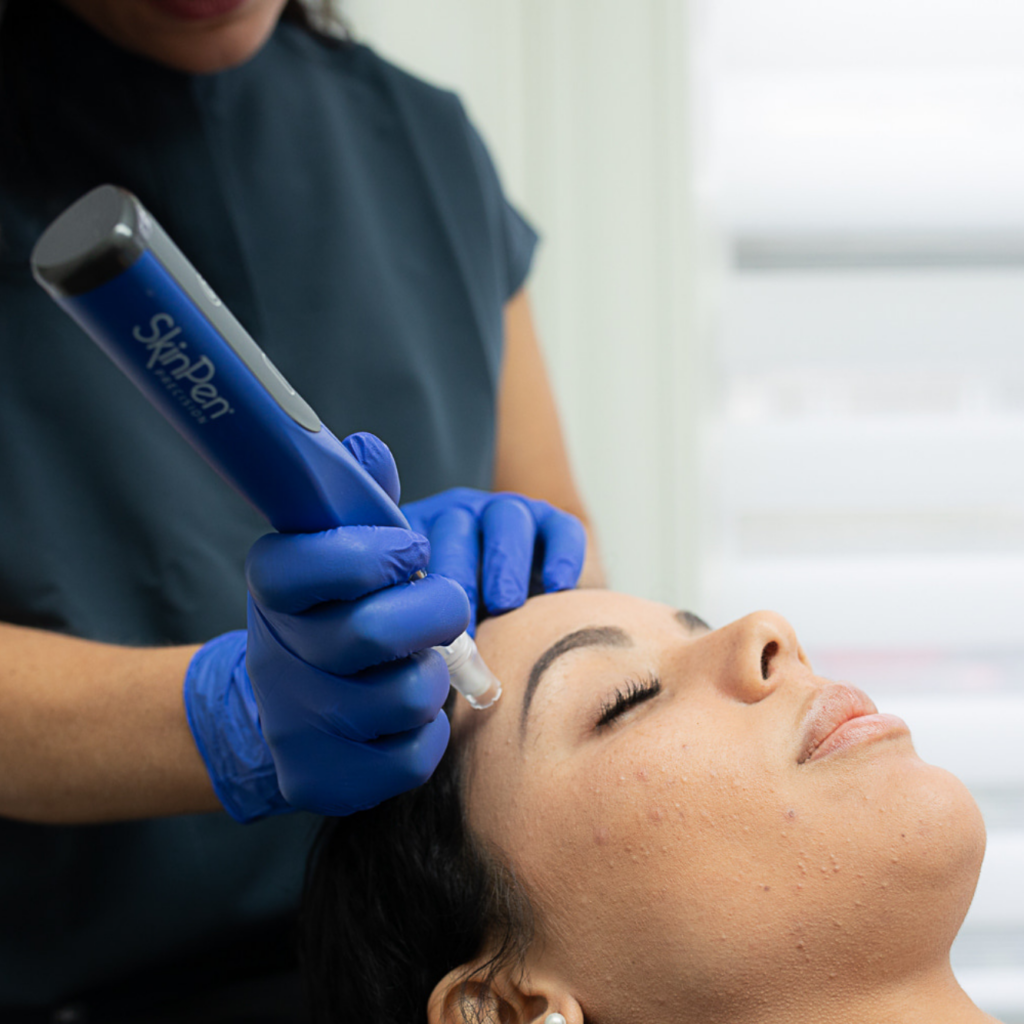 Brighter and younger looking skin with Microneedling in Manchester, NH