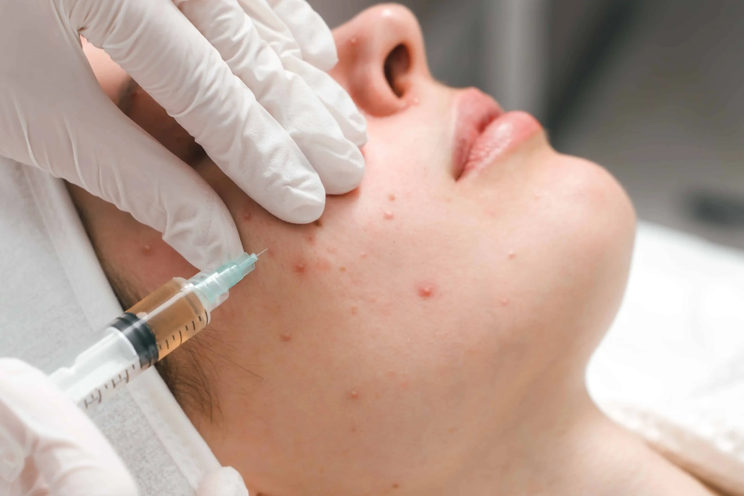 Steroid injection for Acne and Keloid scars in Manchester, NH at The Alchemy Clinic