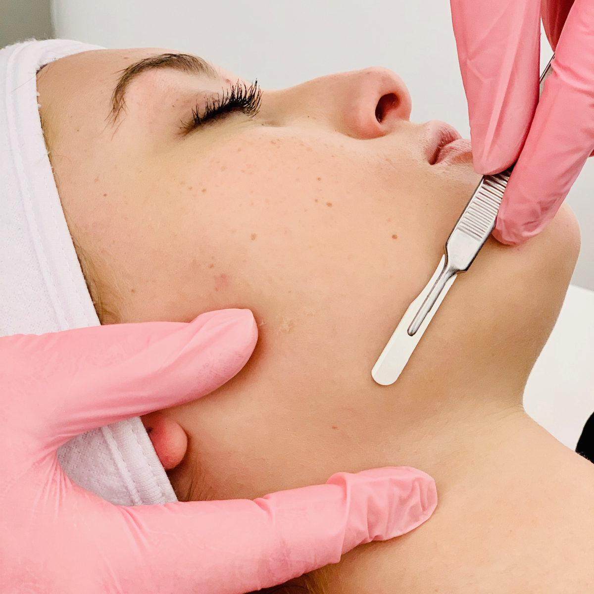 Dermaplaning in Manchester, NH at The Alchemy Clinic
