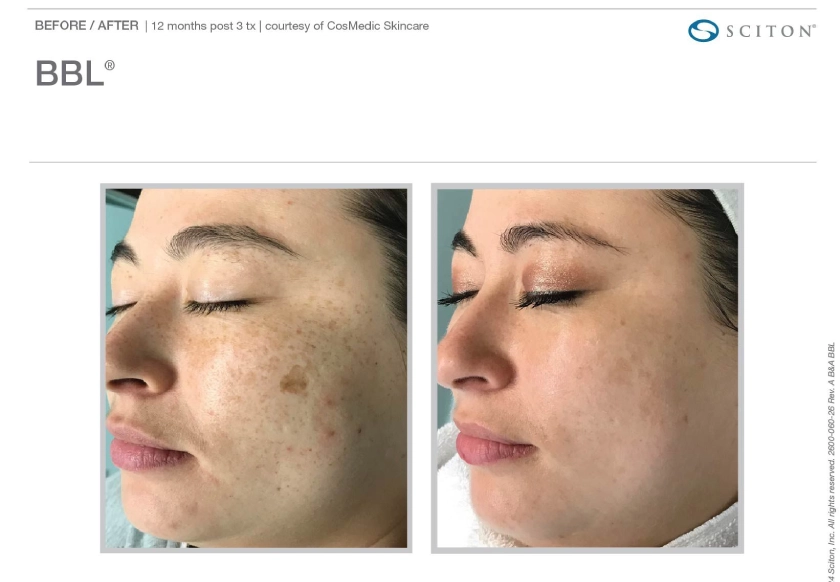 Before and After BBL Heroic treatment at The Alchemy Clinic in Manchester, NH