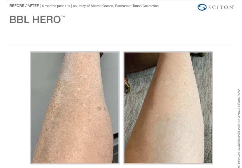 Before and After BBL Heroic treatment at The Alchemy Clinic in Manchester, NH