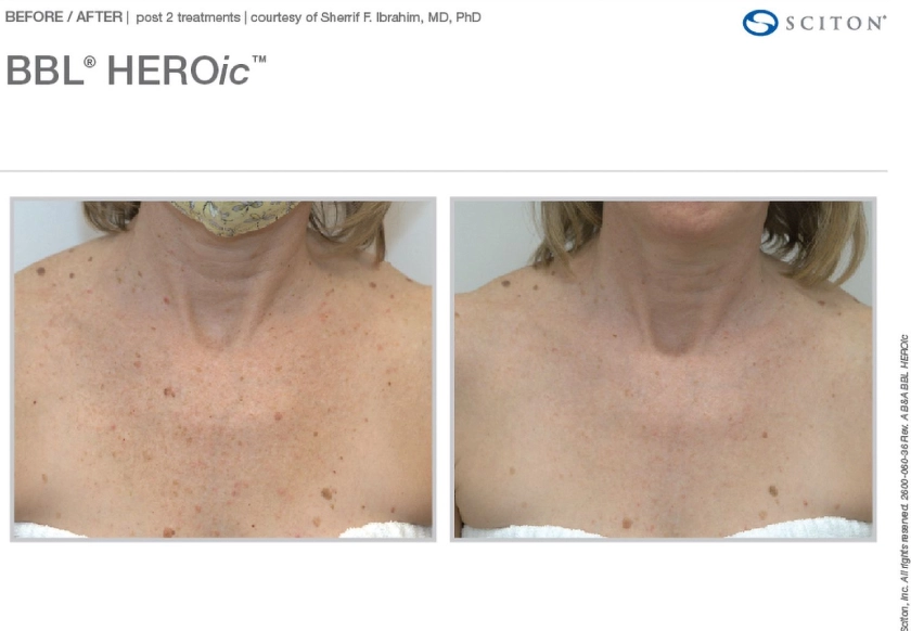 Before and After BBL Heroic treatment at The Alchemy Clinic in Manchester, NH