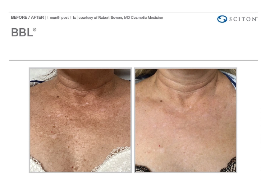 Before and After BBL Heroic treatment at The Alchemy Clinic in Manchester, NH