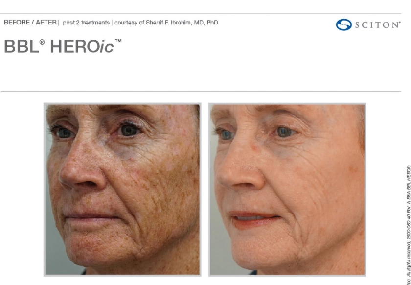 Before and After BBL Heroic treatment at The Alchemy Clinic in Manchester, NH