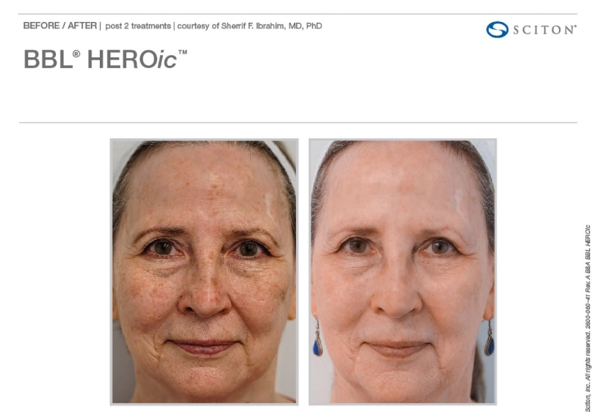 Before and After BBL Heroic treatment at The Alchemy Clinic in Manchester, NH