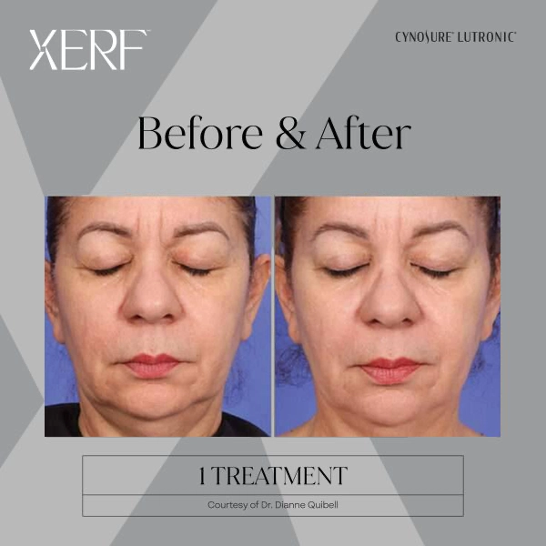 Before-After-XERF (2)