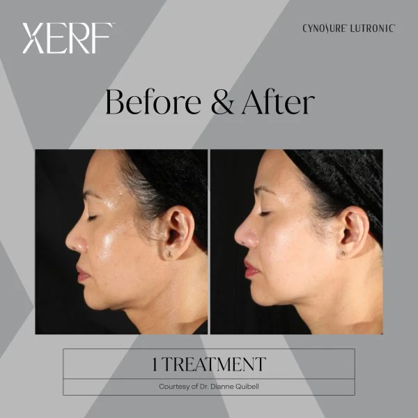 Before-After-Xerf