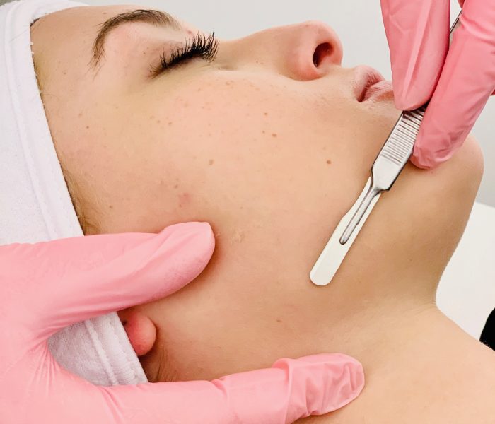 Dermaplaning in Manchester, NH at The Alchemy Clinic