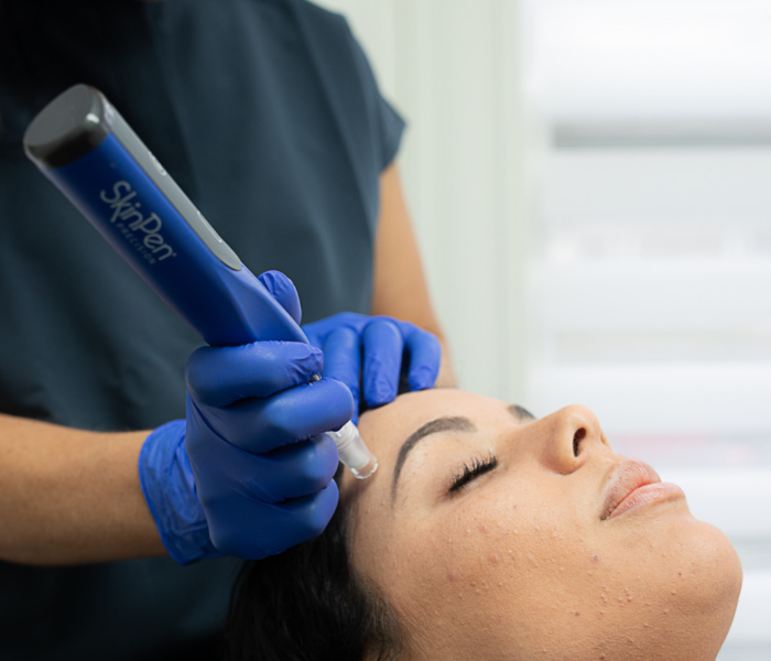 Brighter and younger looking skin with Microneedling in Manchester, NH
