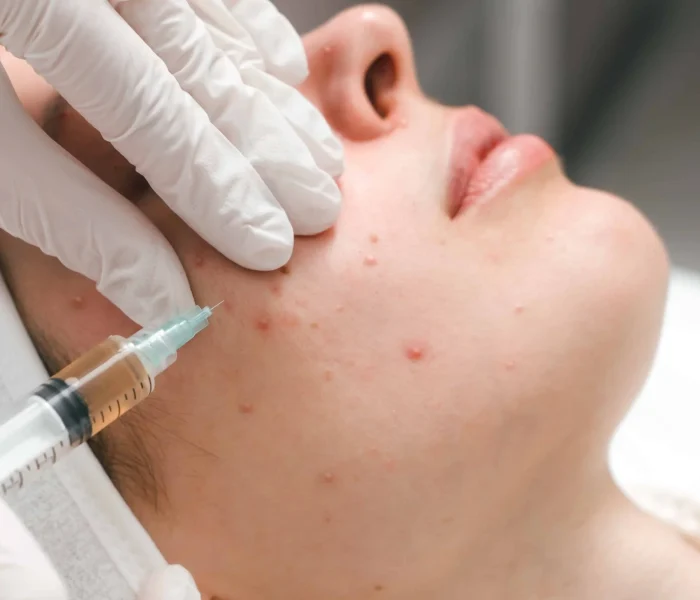Steroid injection for Acne and Keloid scars in Manchester, NH at The Alchemy Clinic