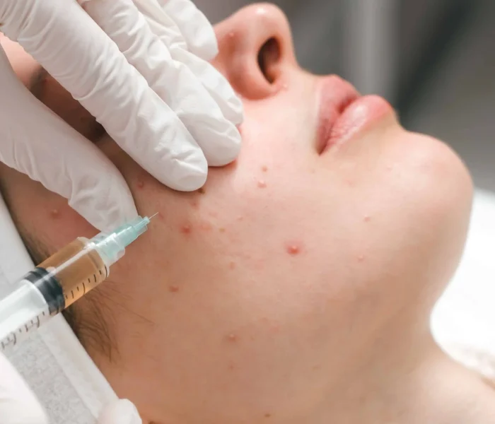 Steroid injection for Acne and Keloid scars in Manchester, NH at The Alchemy Clinic